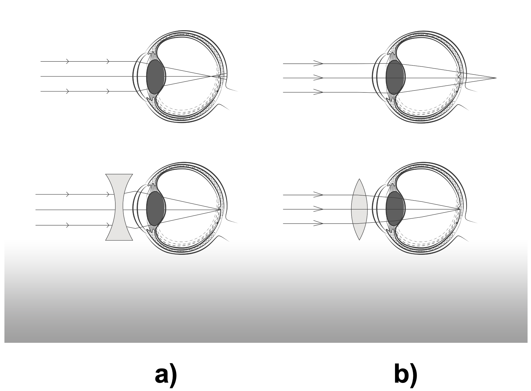 Corrección de la miopía mediante lentes negativas y Corrección de la hipermetropía usando lentes positivas