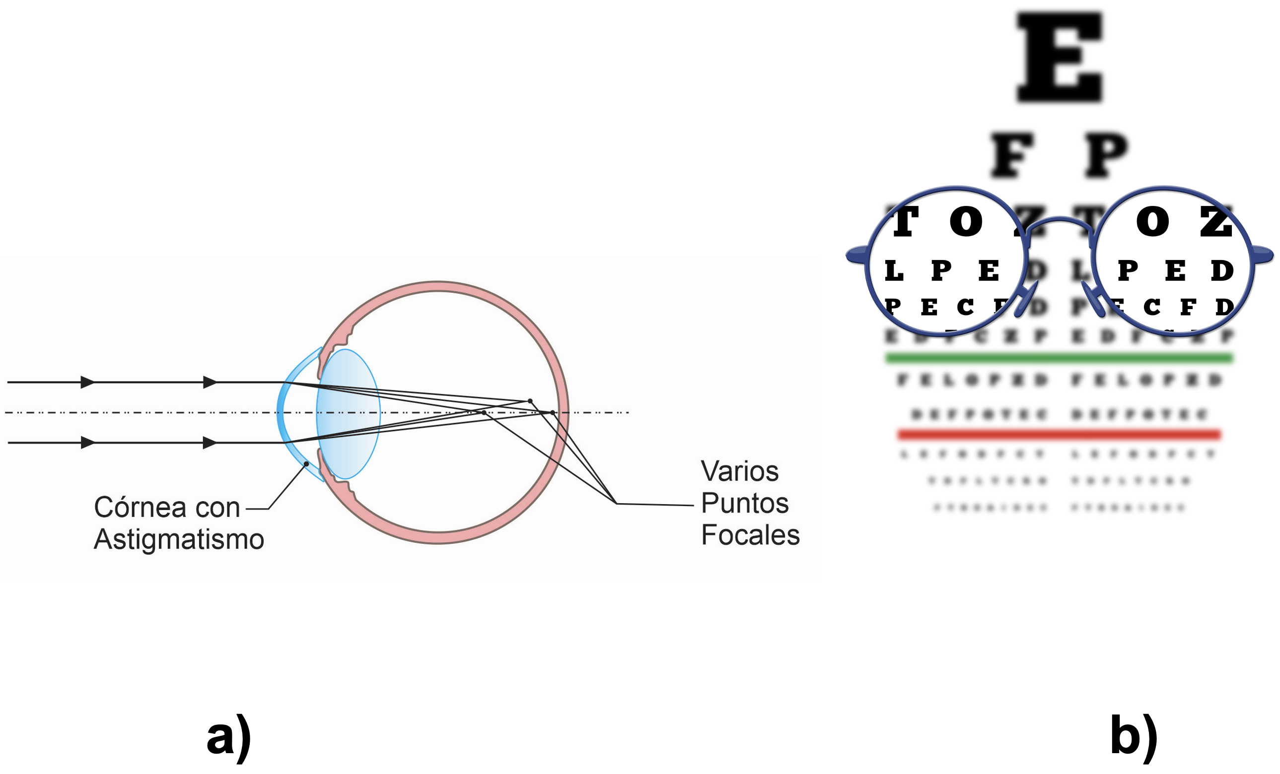 Astigmatismo y visión corregida